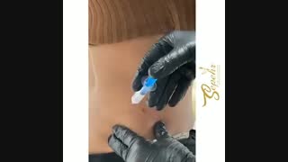 مزوتراپی پهلو | لاغری سریع پهلو