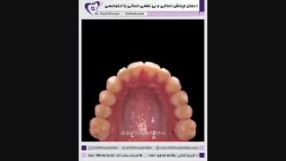 درمان چرخش دندانی و بی نظمی دندانی با ارتودنسی | دکتر فاضل فیروزی