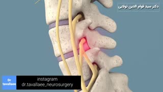 فیلم اندوسکوپی ستون فقرات