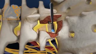 فیلم انیمیشنی تکنیک جراحى سرخوردگى مهره کمر