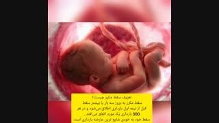 سقط مکرر جنین