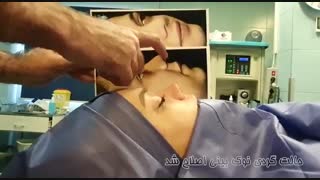 فیلم جراحی زیبایی بینی گوشتی