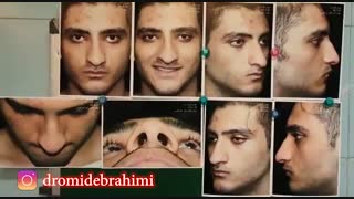 فیلم جراحی افتادگی بینی گوشتی