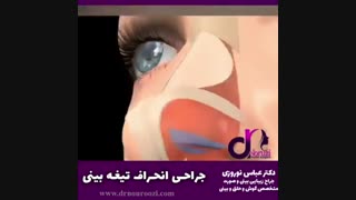 جراحی انحراف تیغه بینی