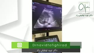 بیوپسی توده کبد با گاید سونوگرافی