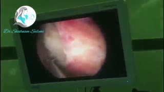 هیسترکتومی خارج کردن فیبروم رحم