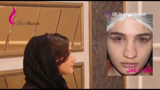 بعد از عمل بینی گوشتی