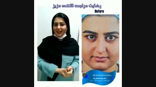 عمل بینی طبیعی زنانه