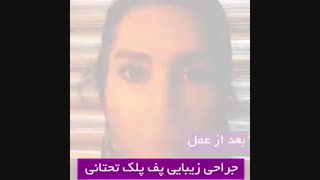 جراحی پلک پلک پایین