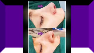 فیلم واقعی جراحی ترمیم بینی