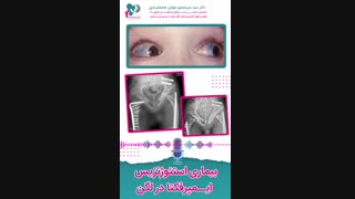بیماری استئوژنزیس ایمپرفکتا در لگن