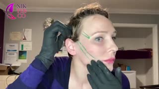 آموزش جایگزاری نخ لیفت روی صورت پزشک