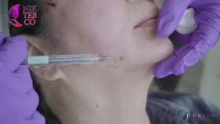 آموزش تزریق همزمان ژل و لیفت با نخ