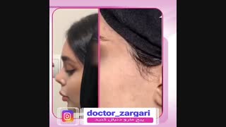 جراحی زیبایی بینی نیمه فانتزی