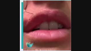 فیلم واقعی تزریق ژل لب