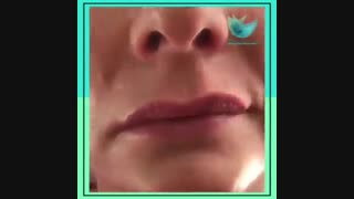 فیلم فرم دهی لب با تزریق ژل