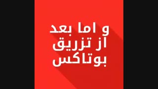 فیلم تزریق بوتاکس