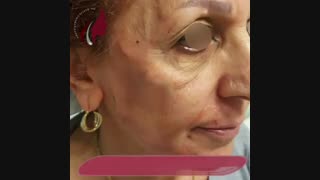 فیلم واقعی لیفت صورت با نخ