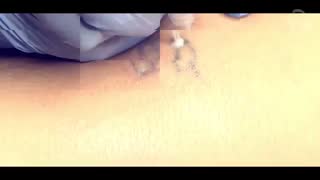 پاک-کردن-تاتو-بدن