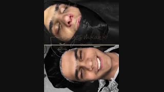 فیلم واقعی قبل و بعد از عمل بینی