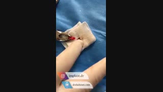 جراحی یک واحد ایمپلنت فوری توسط دکتر شهرام اسعدی رفع غبغب