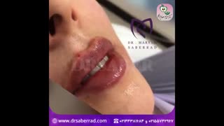 تزریق فیلرژوویدرم به لب