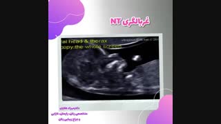 غربالگــرے Nt