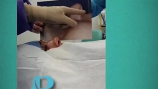 بعد از عمل جراحی زیبایی بینی