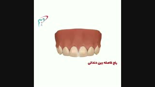 از بین بردن فاصله بین دندان