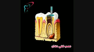 مراحل عصب کشی دندان