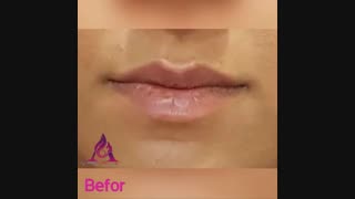 فیلم نمونه واقعی تزریق فیلر لب