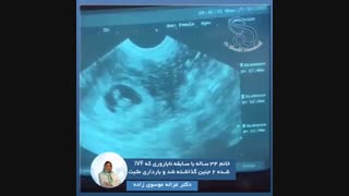 بارداری مثبت به روش IVF