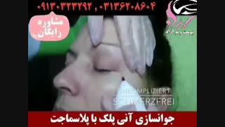 پلاسماجت لیزر موهای زائد