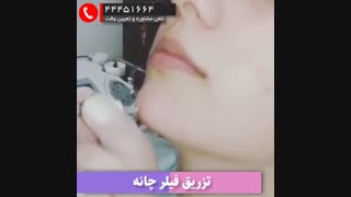تزریق ژل چونه