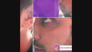 فیلم نتیجه جذاب زاویه سازی فک و چانه