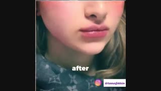 فیلم واقعی از تزریق ژل لب، فک و چانه