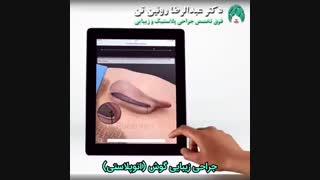 جراحی زیبایی گوش ( اتوپلاستی )
