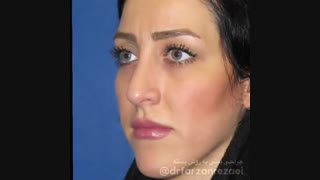 جراحی بینی و تزریق چربی به زاویه فک