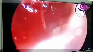 فیلم واقعی درمان سینوزیت قارچی