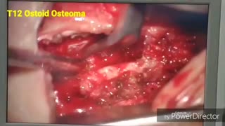 راه رفتن بیمار در ریکاوری بلافاصله بعد از عمل جراحی تومور مهره دوازدهم توراسیک