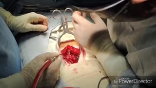 عمل سر خوردگی مهره های کمر