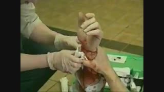 جسم خارجی در زخم -فیلم14 (2)