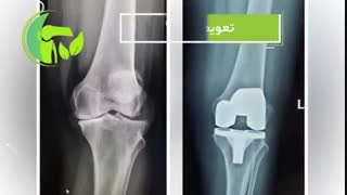 فیلم واقعی تعویض مفصل زانو در شیراز