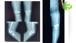 فیلم بدون سانسور قبل و بعد تعویض دوطرفه مفصل زانو