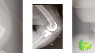 فیلم واقعی تعویض مفصل زانو