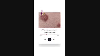 ⚠️موارد مهمی که در مورد زگیل تناسلی باید بدانید⚠️