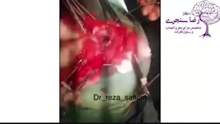 فیلم تخلیه کامل تومور مننژیوم قاعده مغز
