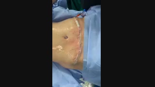 ابدومینوپلاستی و لیپوماتیک پهلو با پال