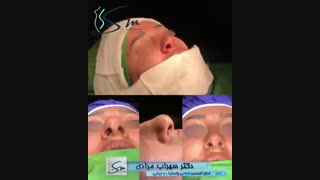 نمونه عمل زیبایی بینی