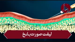 فیلم واقعی لیفت صورت با نخ